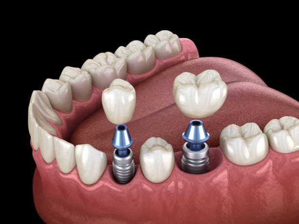 What Do Dental Implants Look Like?