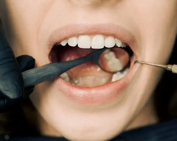 signs of a cavity between teeth everything you need to know